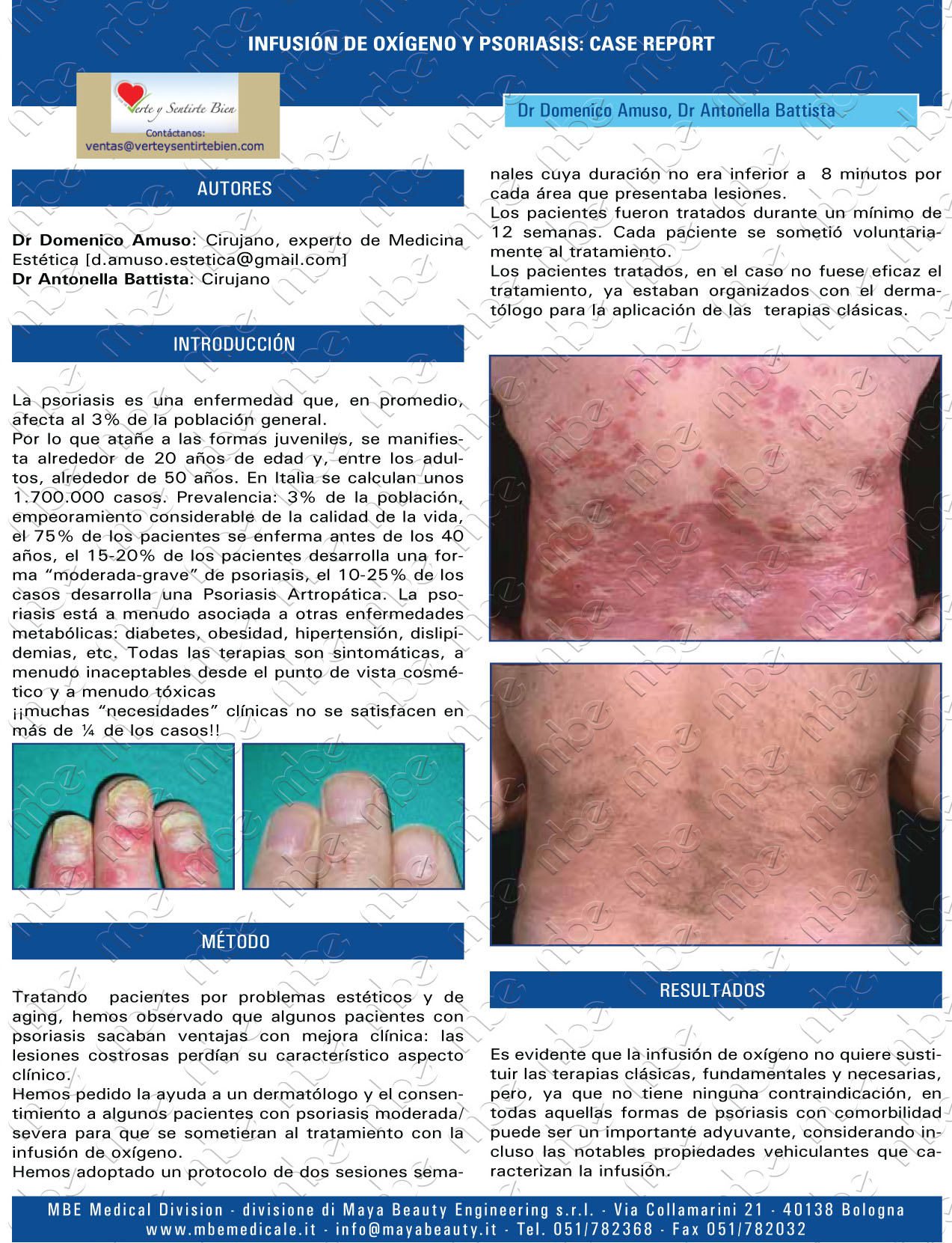 como tratar la soriasis